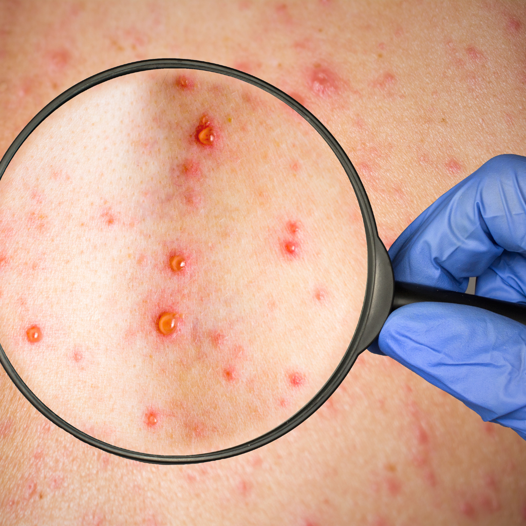 Lee más sobre el artículo PRIMER CASO DE VIRUELA DEL MONO EN CHILOÉ