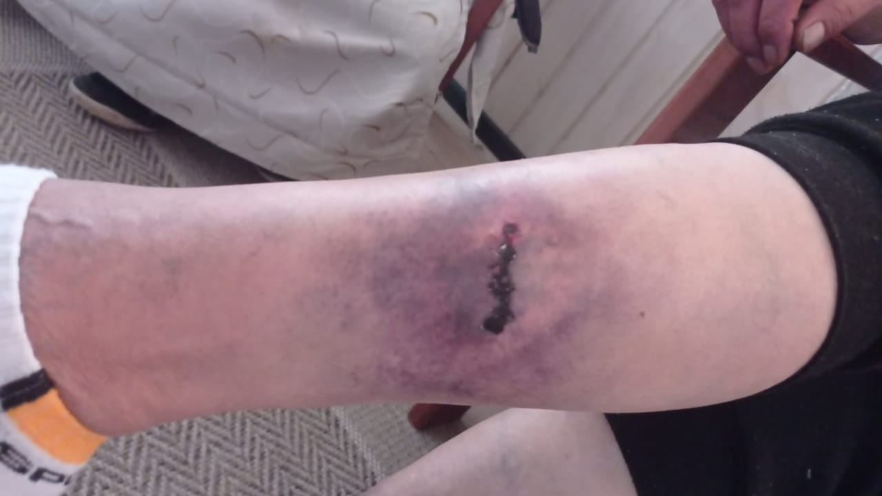 Lee más sobre el artículo Jauría de perros ataca a mujer de 55 años en población Salvador Allende de Castro