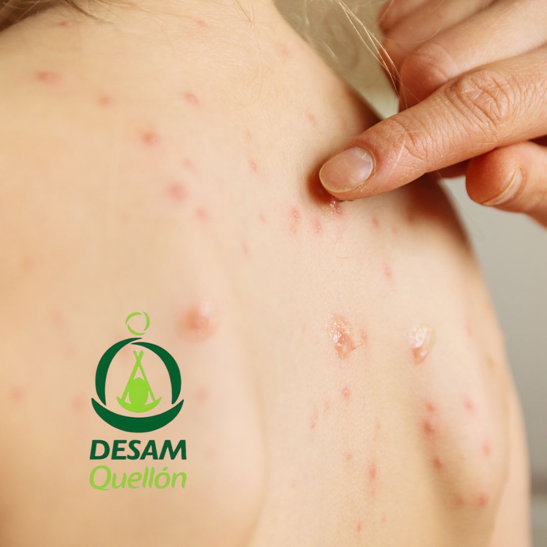 Lee más sobre el artículo ¿Qué hacer si tu hijo tiene varicela? Conoce los síntomas y los cuidados necesarios